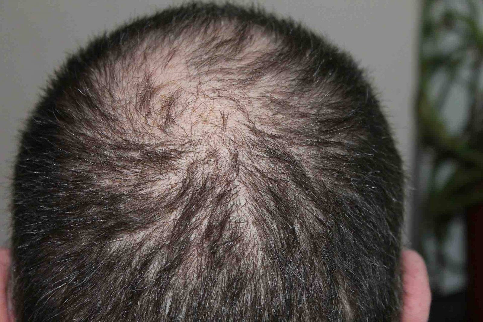 Top of man's head showing hair loss and thinning